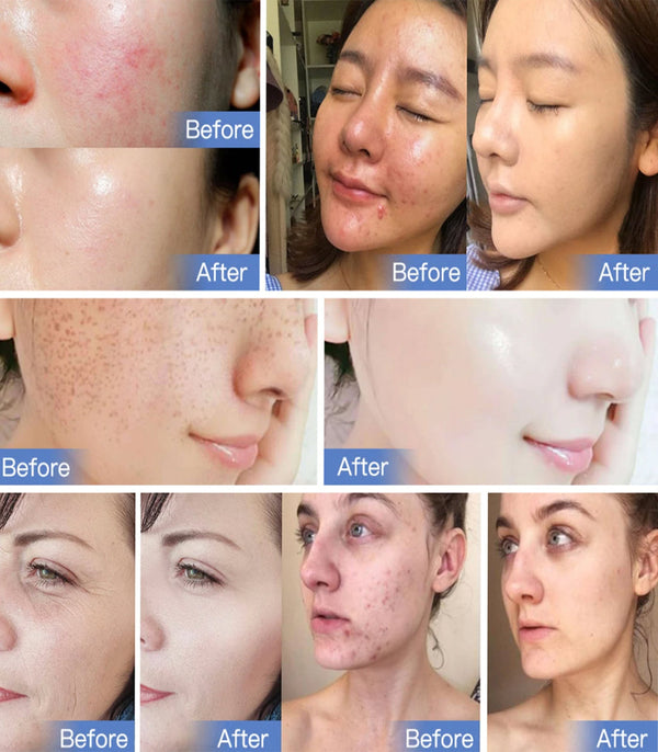 7 Colors LED Light Therapy Machine - The Ultimate Solution For Your Skincare Needs